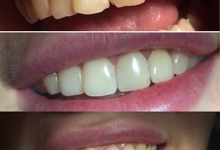 Керамические виниры E-max на зубы